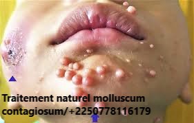 Molluscum Contagiosum Causes Traitement Naturel