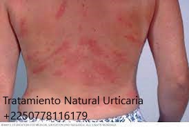 Urticaria Definición Causas Tratamiento Natural Urticaria