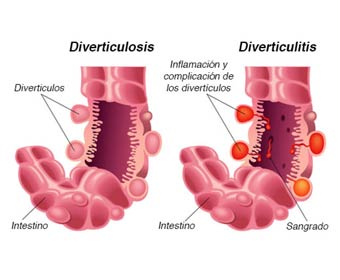 Diverticulosis Causas Diverticulosis Tratamiento Natural