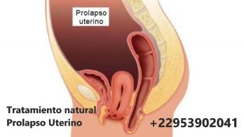 Prolapso Uterino Definición Causas Tratamiento Natural Prolapso Uterino