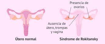 Síndrome de Rokitansky Tratamiento Natural Síndrome de Rokitansky